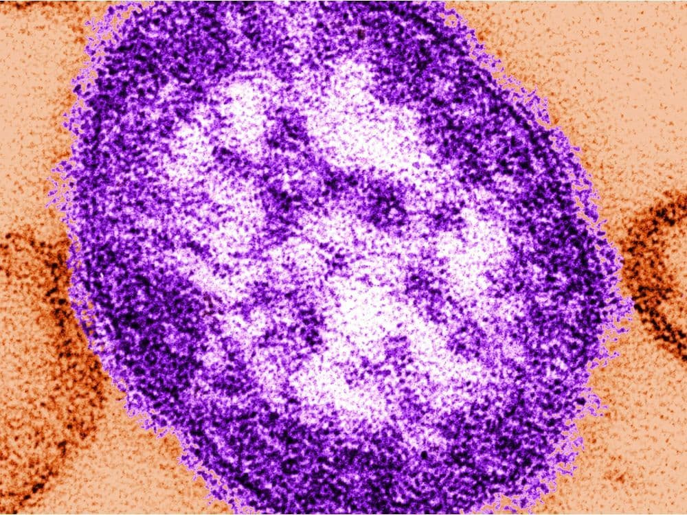 Measles declared public health emergency before April?